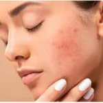 Dark spots ko kaise hataye